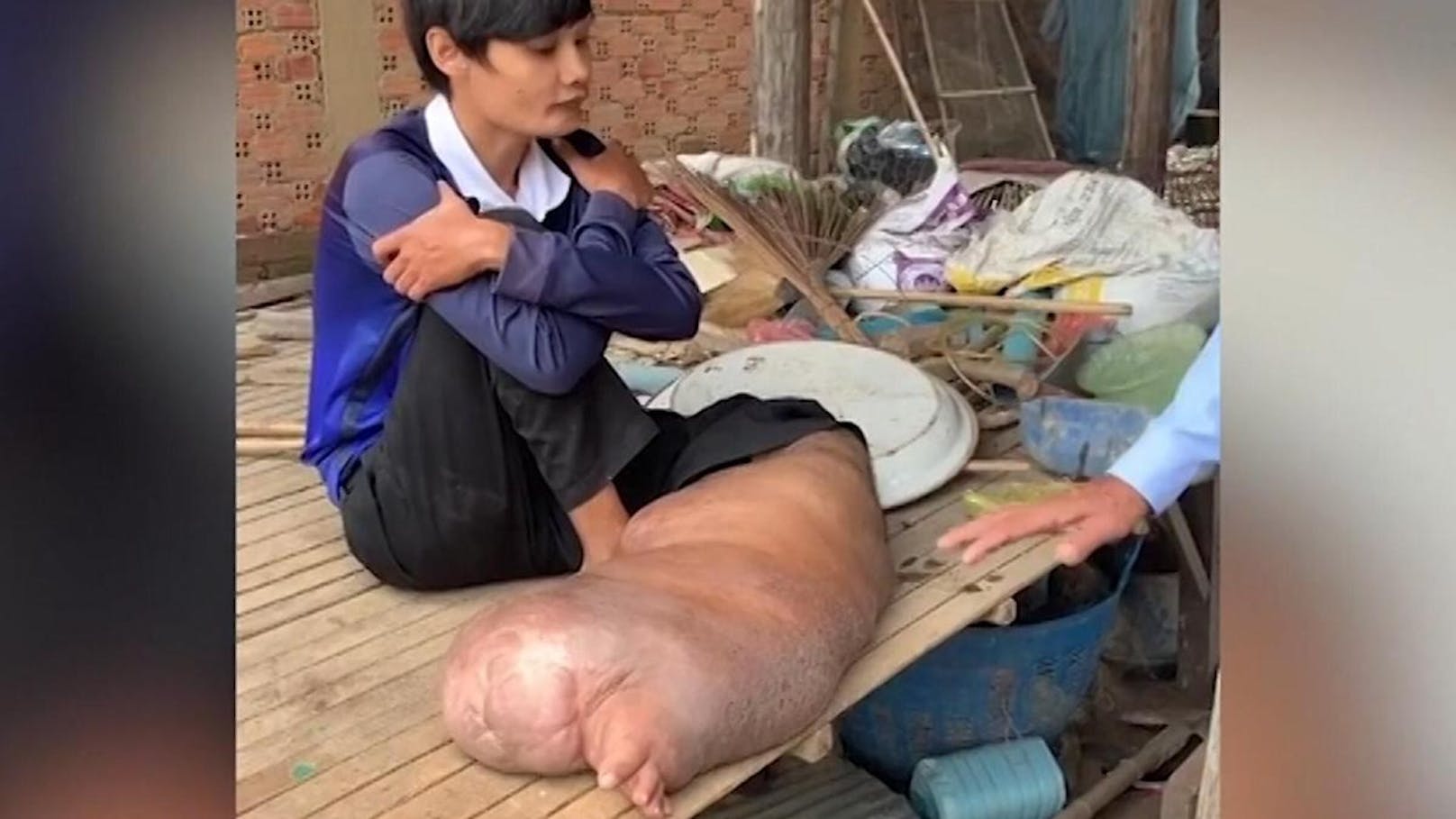 27-Jähriger leidet unter riesigem Elefantenfuß
