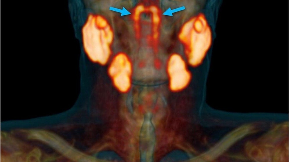 Mediziner scheinen neue Speicheldrüsen entdeckt zu haben.