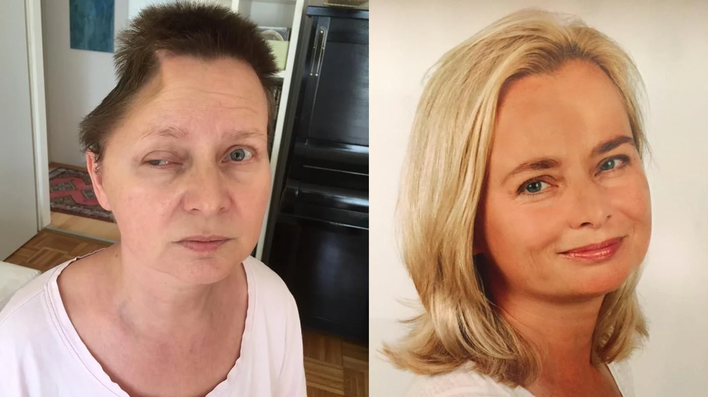 Andrea Golda (52) vor und nach ihrem Unfall