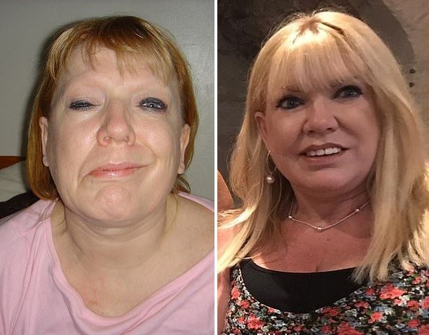 Sie litt unter einer halbseitigen Gesichtslähmung. Botox brachte ihr wieder ein "gerades" Gesicht.