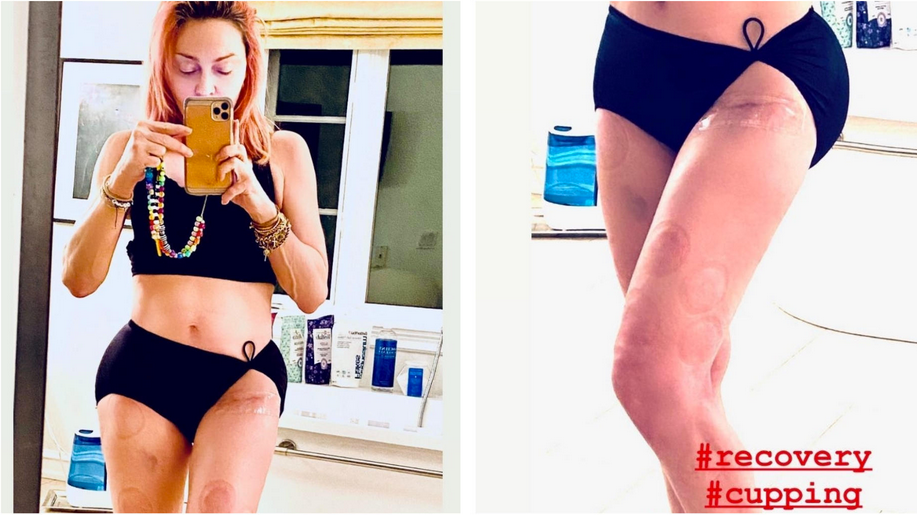 OP-Narbe und Schröpf-Andenken: <strong>Madonna</strong> zeigt auf Instagram stolz ihre Blessuren.<br>