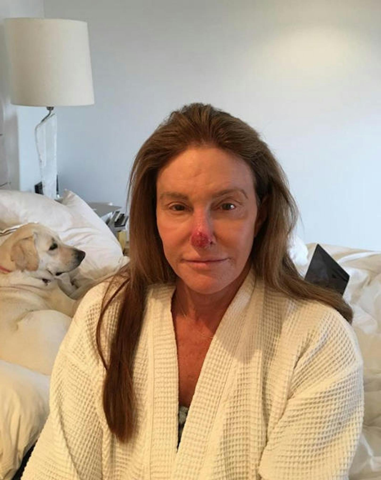 21.03.2018: Caitlyn Jenner teilt ihren Fans auf Instagram mit, dass ihr ein Tumor auf der Nase entfernt worden ist. Weil sie in den 60er- und 70er-Jahren auf Sonnencreme verzichtet hat, muss sie nun mit den Spätfolgen kämpfen.
