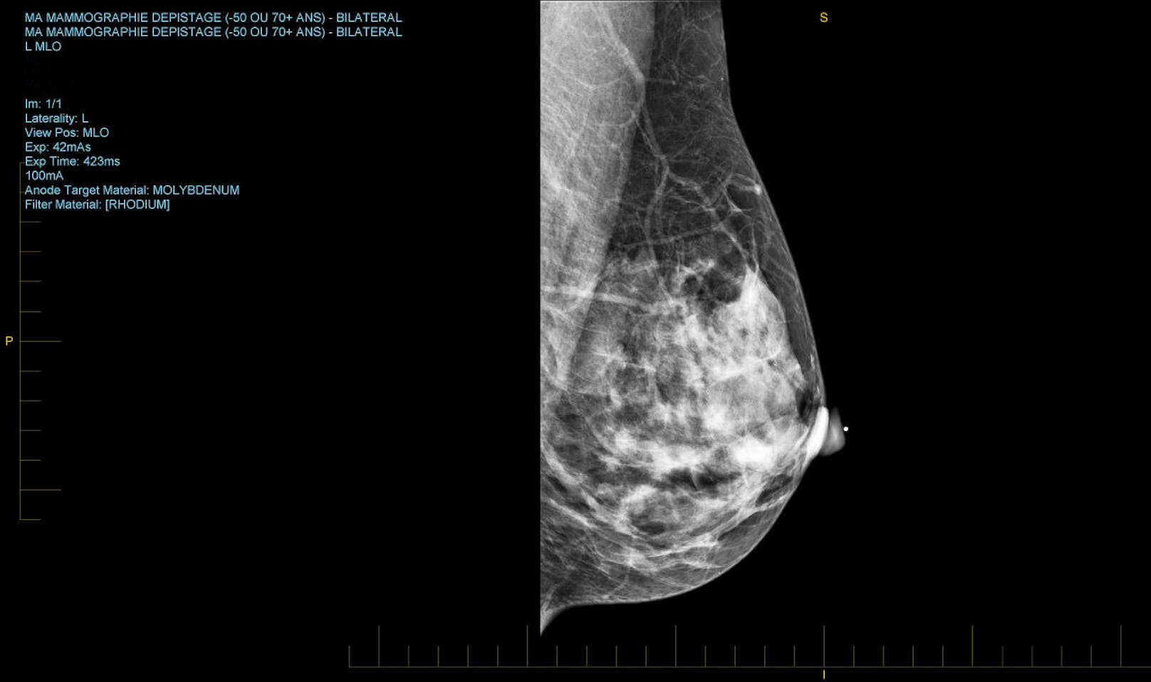 Das Tückische bei Brustkrebs ist: Die meisten Patientinnen sterben nicht durch den Tumor selbst,...