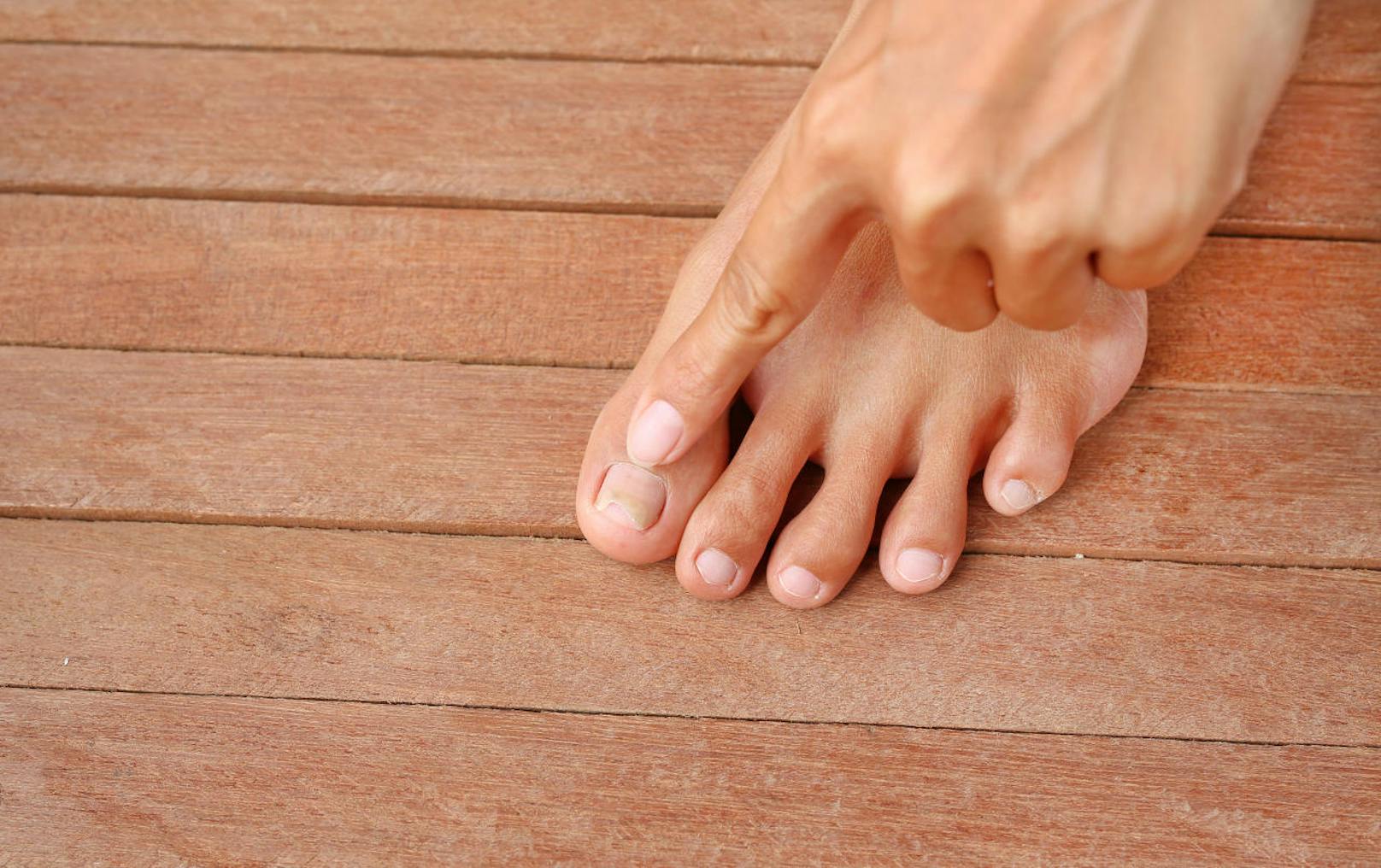 <b>Brüchige Nägel</b>
Das womöglich häufigste Fußnagel-Symptomsind brüchige Nägel. Die möglichen Ursachen: Stress, Mineralstoffmangel oder der Einsatz von zu viel Nagellackentferner. Und was hilft? Zum Beispiel glättende Nagelöle oder Tinkturen mit Urea und Panthenol. 