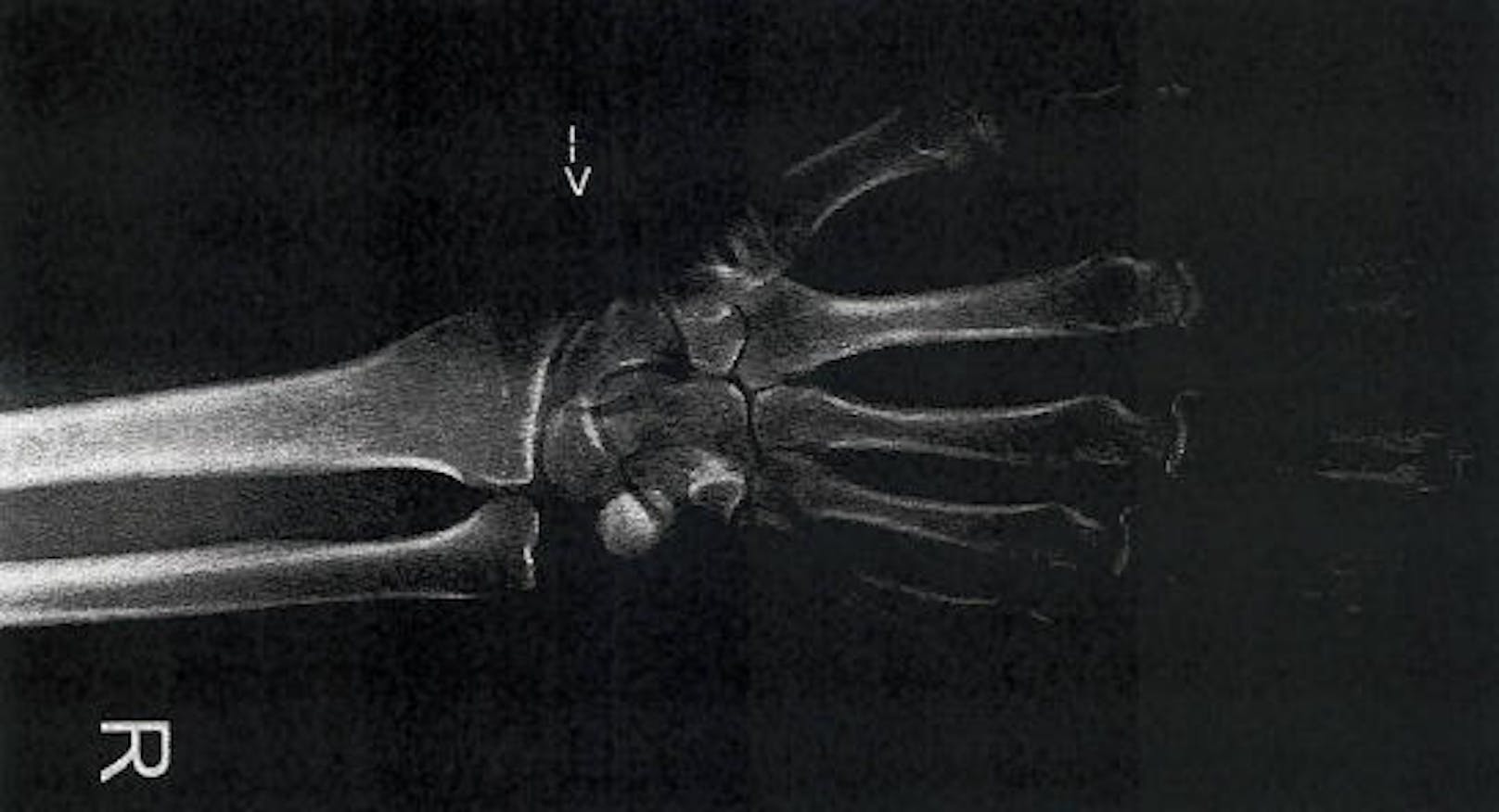 Röntgenaufnahme der rechten Hand vom 7.12.2017.