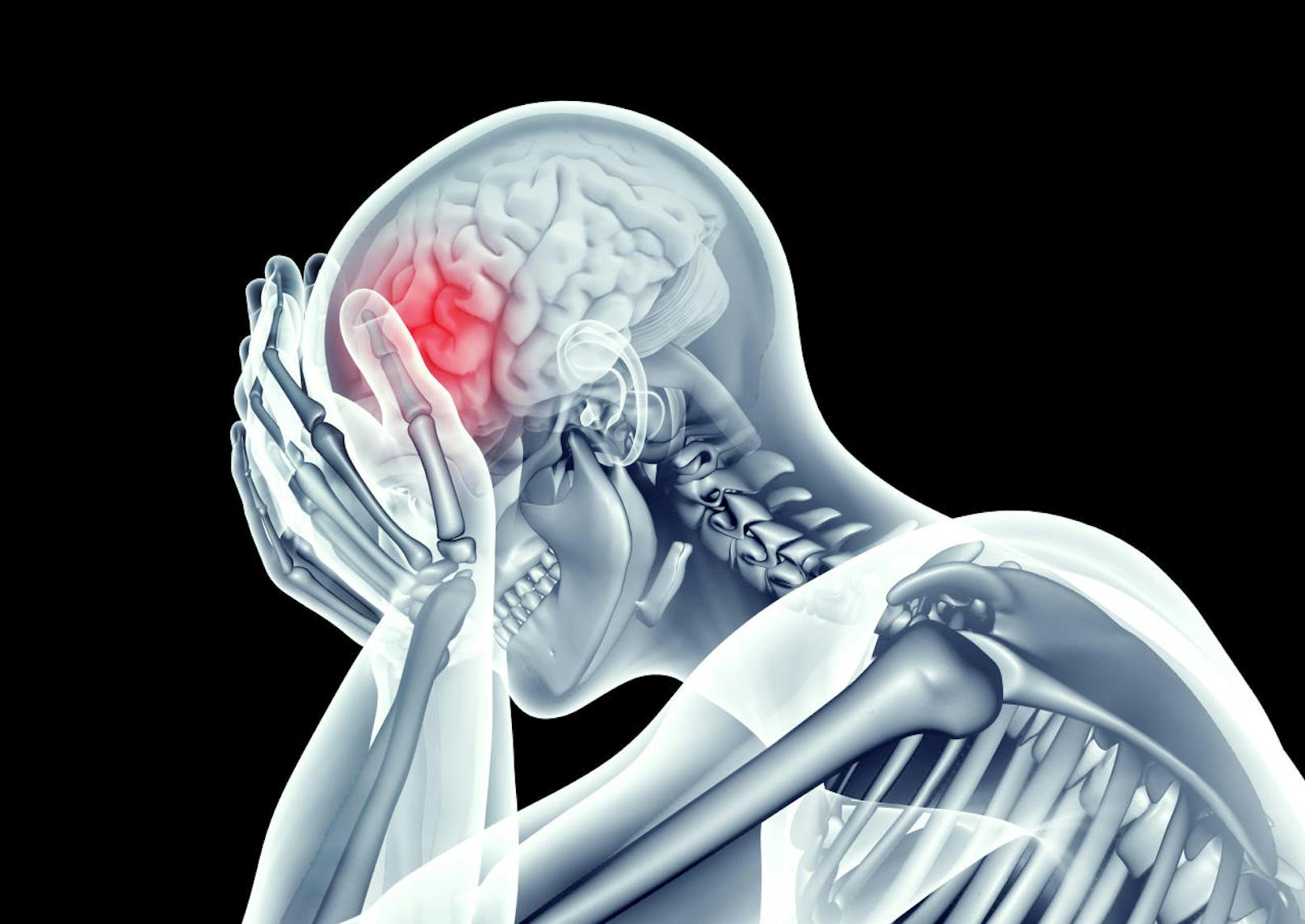 Fest steht, dass die Migräne eine neurobiologische Funktionsstörung ist und erbliche Faktoren eine Rolle spielen.