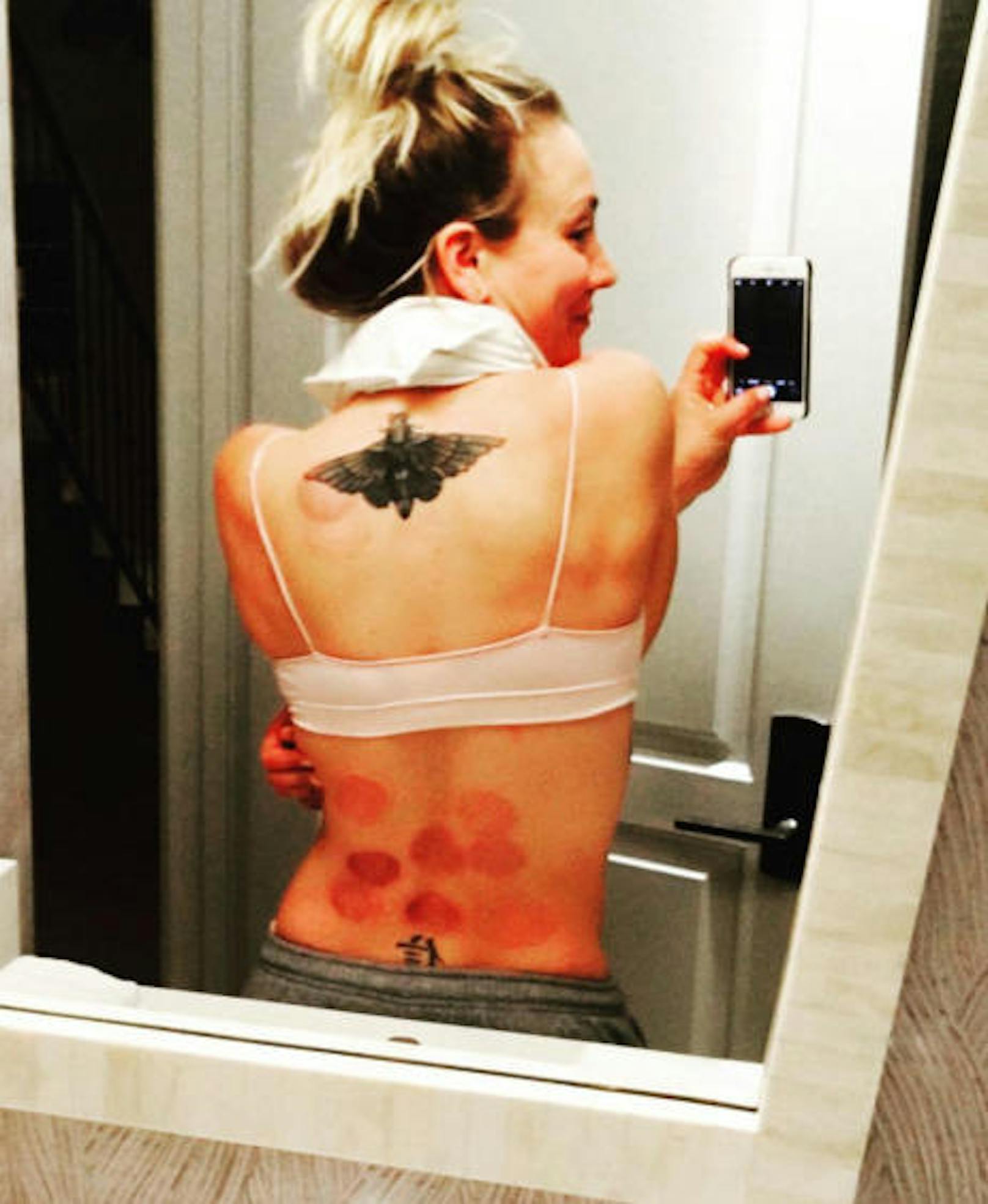 21.10.2016: Ui - Auch Kaley Cuoco hat sich Schröpfen lassen und zeigt das Ergebnis der Massage-Behandlung auf Instagram.