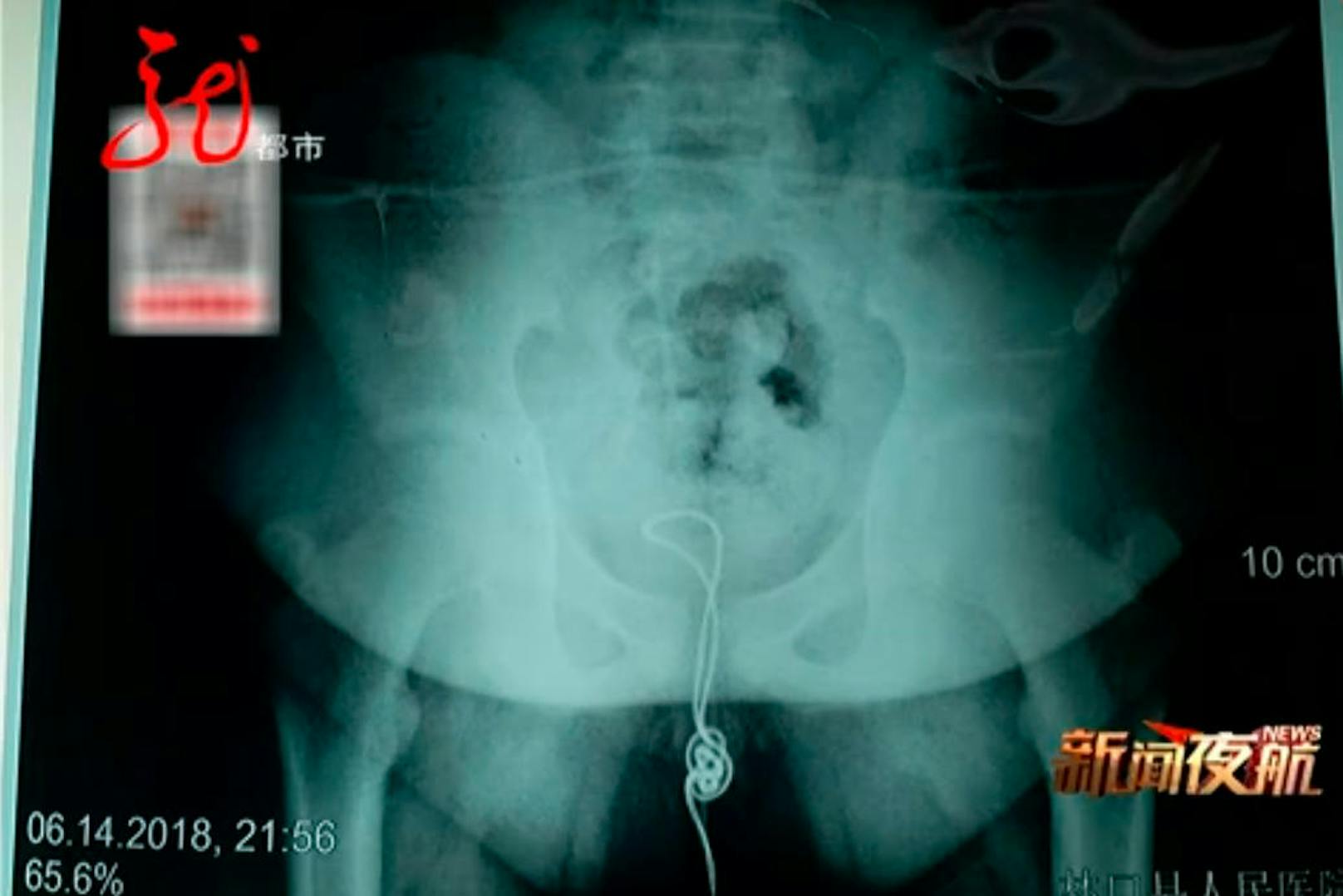 Auch die Ärzte scheiterten beim Versuch, den rund 20 Zentimeter langen Fremdkörper aus der Harnröhre des Buben zu ziehen. Den Grund offenbarte eine Röntgenaufnahme: Das Kabel hatte sich im Körper des Buben verheddert.