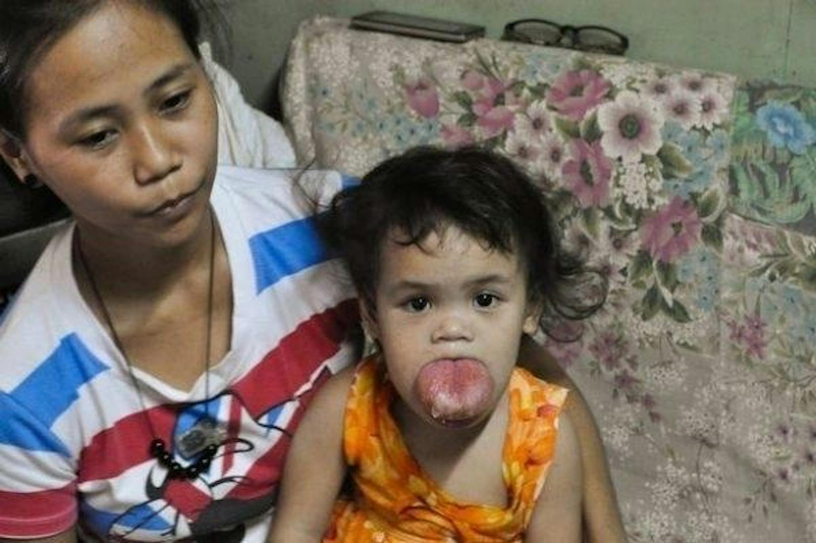 Die Zunge der 2-jährigen Zhyrille Cruz ist viel größer als ihr Mund. Wird ihr nicht bald geholfen, könnte das Mädel sterben.