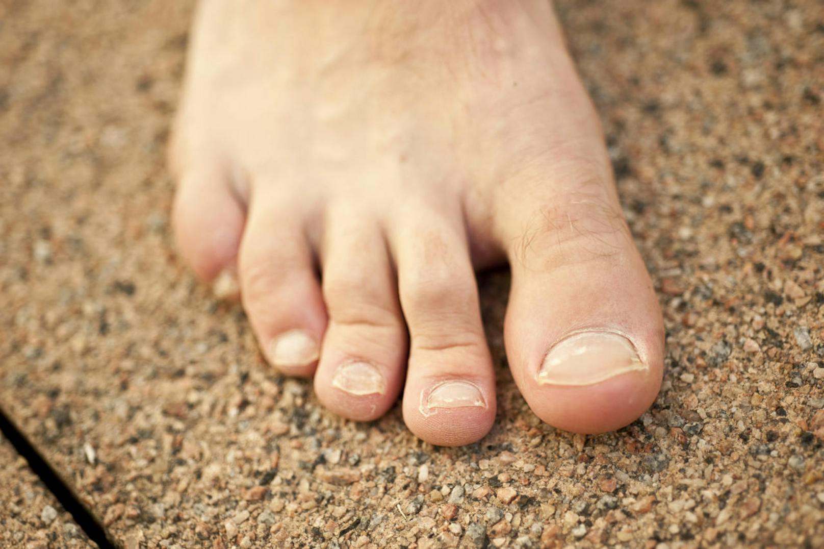 <b>Weiße Flecken </b>
Kleine weiße Punkte auf den Nägeln? Mediziner sprechen bei weißlichen Verfärbungen der Fußnägelauch von Leukonychie. Doch keine Bange: Dieses Fußnagel-Signal ist eher ungefährlich und kommt bei vielen Menschen vor. Meist entstehen die weißen Flecken durch harmlose Quetschungen des Nagels.