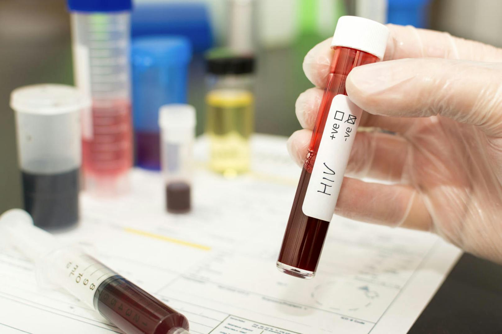 Im vergangenen Jahr lebten rund 9,4 Millionen Menschen mit dem HI-Virus auf der Erde, ohne dies zu wissen: Blutanalyse in einem Labor in Lausanne.