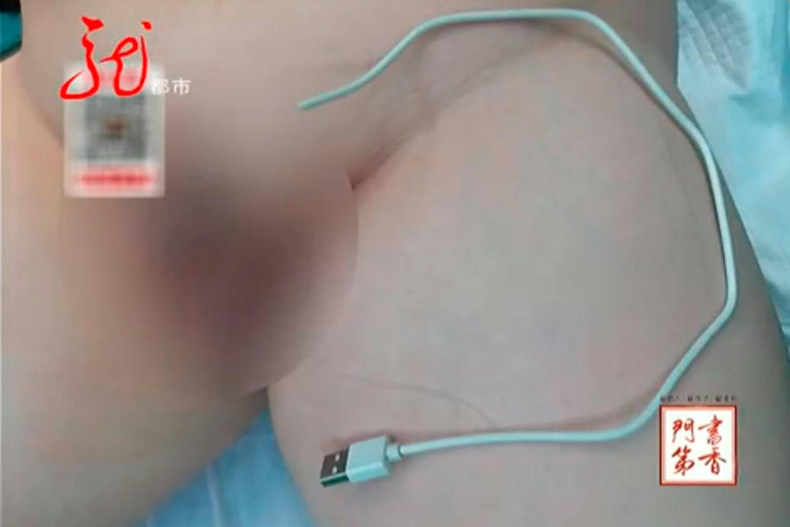 Die Ärzte im Harbin-Kinder-Spital in China dürften sich ein wenig gewundert haben: Sie hatten es mit einem 13-Jährigen zu tun, der ein USB-Kabel in seinen Penis eingeführt hatte und es nicht wieder herausziehen konnte - es steckte fest.