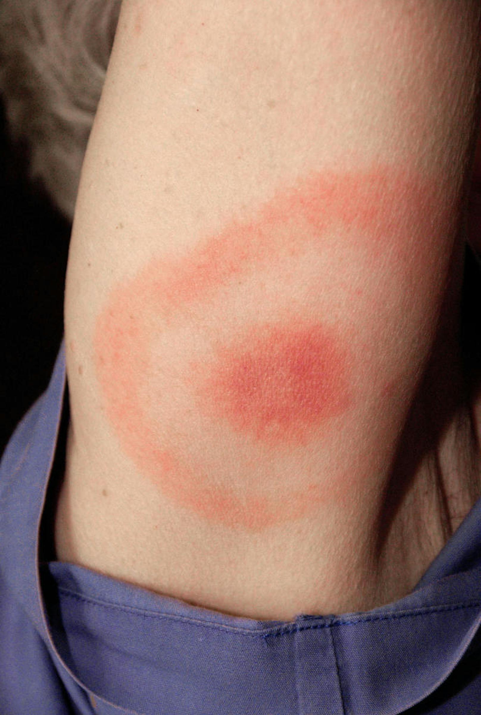 Rötungen in Form einer Zielscheibe nach einem Zeckenbiss können ein Anzeichen für eine Ansteckung mit Lyme-Borreliose sein. Eine Borrelieninfektion durch Zecken ist - im Gegensatz zu der durch Viren hervorgerufenen FSME - sogar in Städten möglich.