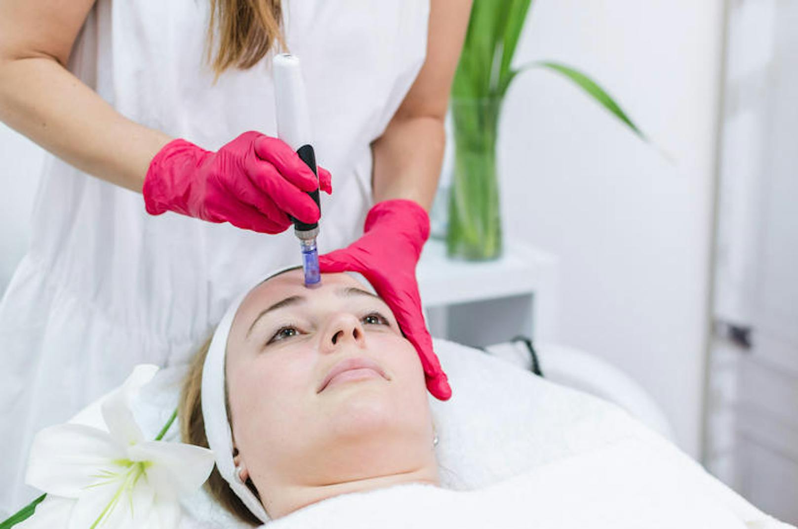 Microneedling wird von Dermatologen und ausgebildeten Kosmetik-Salons durchgeführt, um Aknenarben und feine Linien zu bekämpfen.