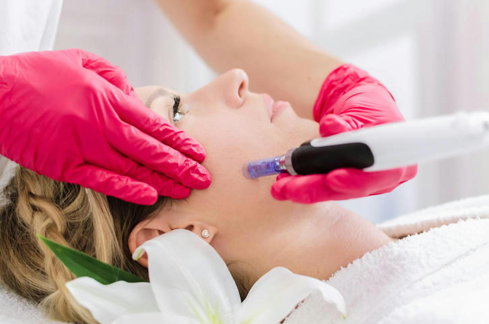 Microneedling wird von Dermatologen und ausgebildeten Kosmetik-Salons durchgeführt, um Aknenarben und feine Linien zu bekämpfen.