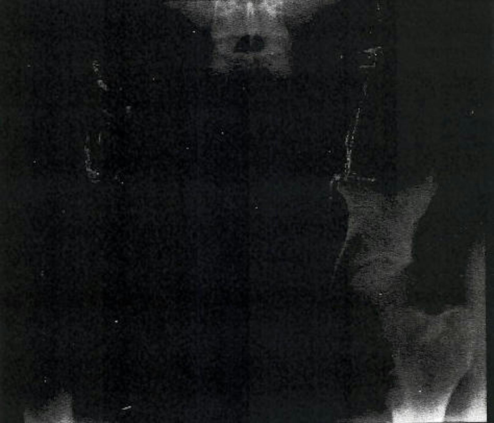 Röntgenaufnahme des Beckens am 29.5.2013. (Bereits damals wurde eine Untersuchung in Pakistan durchgeführt.)