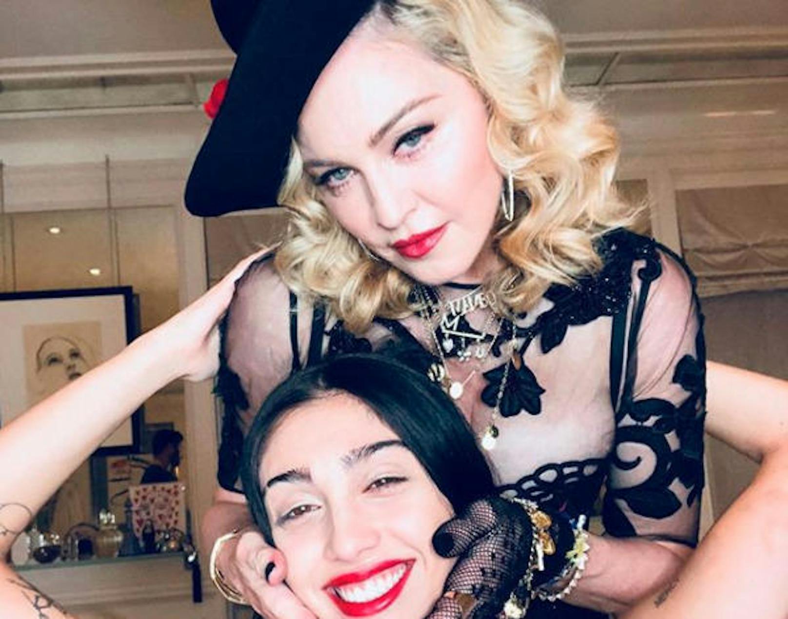 Dass Madonna Botox liebt, ist bekannt. Allerdings verwendet sie auch Filler, die ihr Gesicht aufgedunsen wirken lassen.