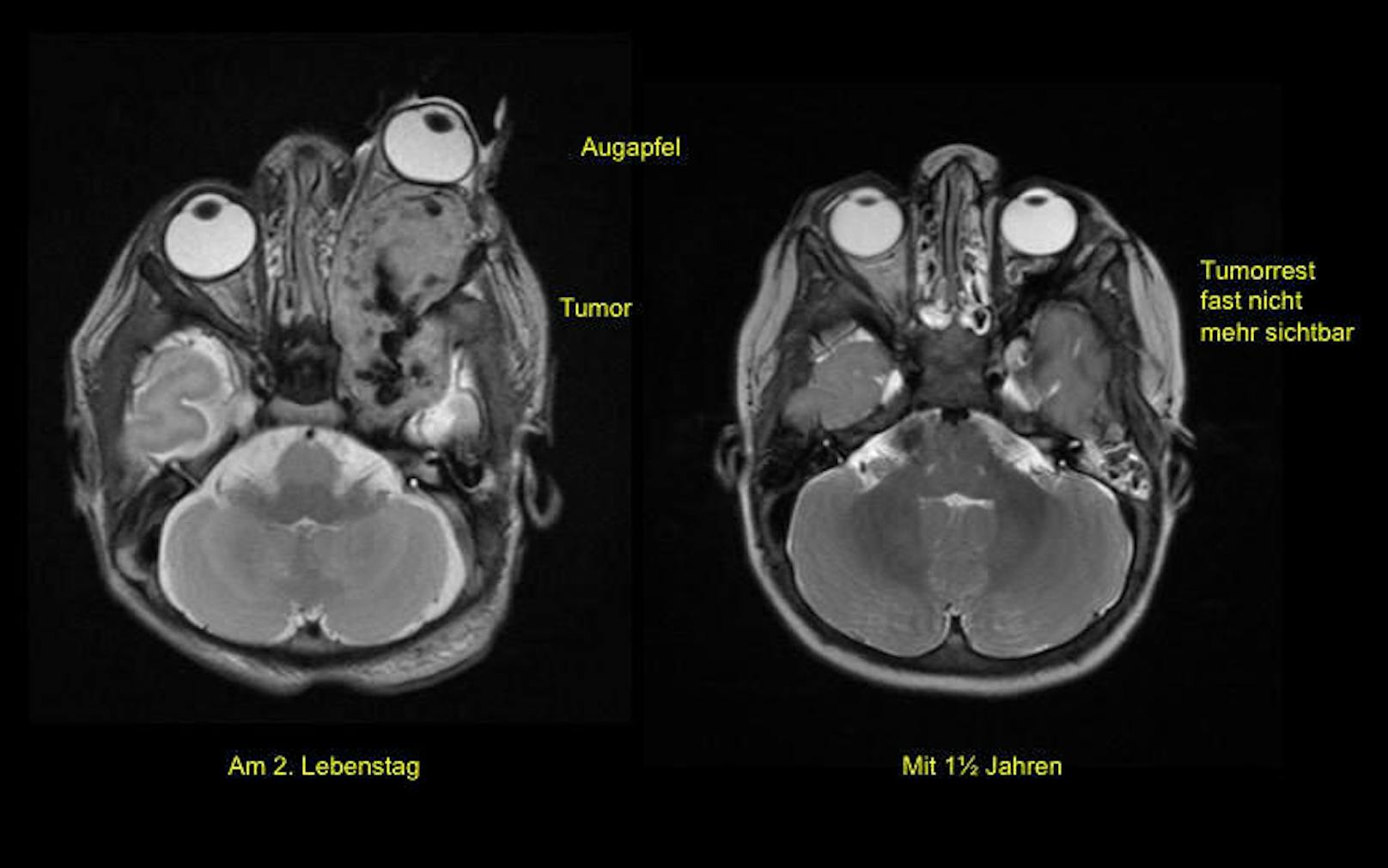 MRI-Bilder zeigen, dass sich das Auge links vollständig außerhalb der Augenhöhle befand. Rechts das Auge <a href="https://www.heute.at/life/gesundheit/story/49028157" target="_blank">nach der erfolgreichen Behandlung mit einem neuartigen Medikament.</a>