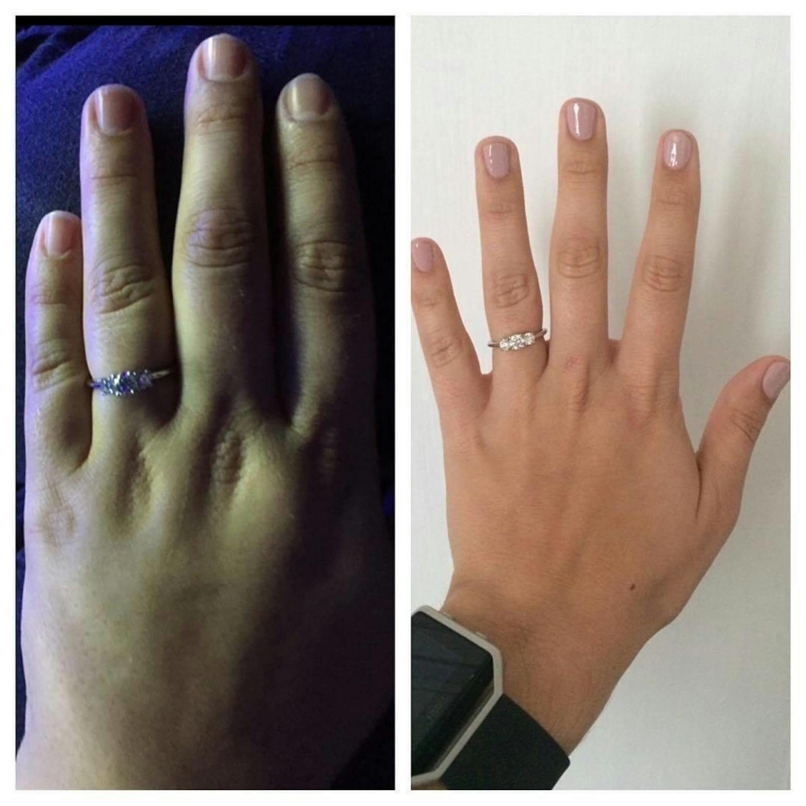 Das linke Foto zeigt ihre Hand vor der Diät. Sie fühlte sich so, als ob sie ständig geschwollene Finger hätte. 
