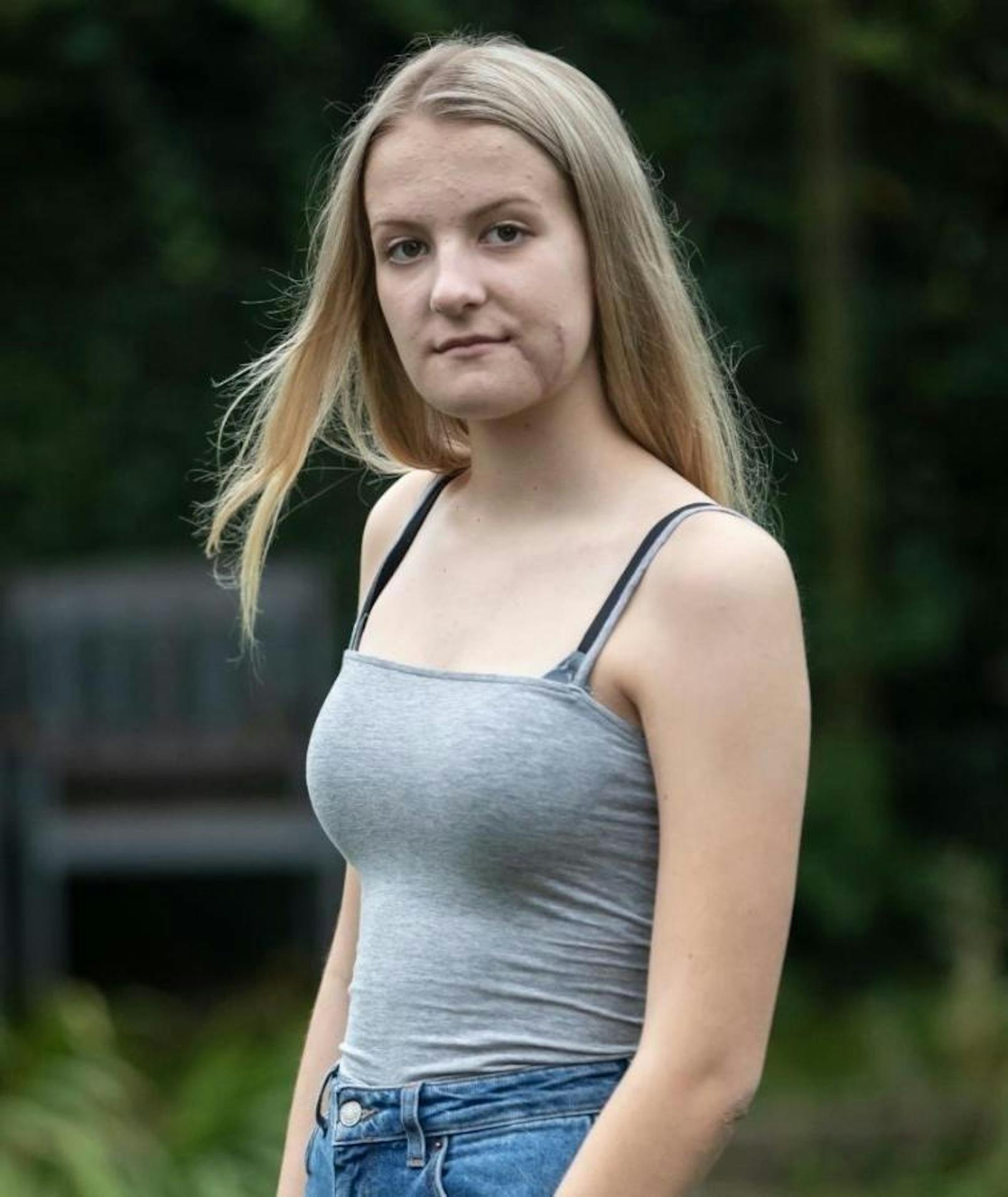Emily Eccles (15) ist nach einer fünfeinhalbstündigen OP wieder fit.
