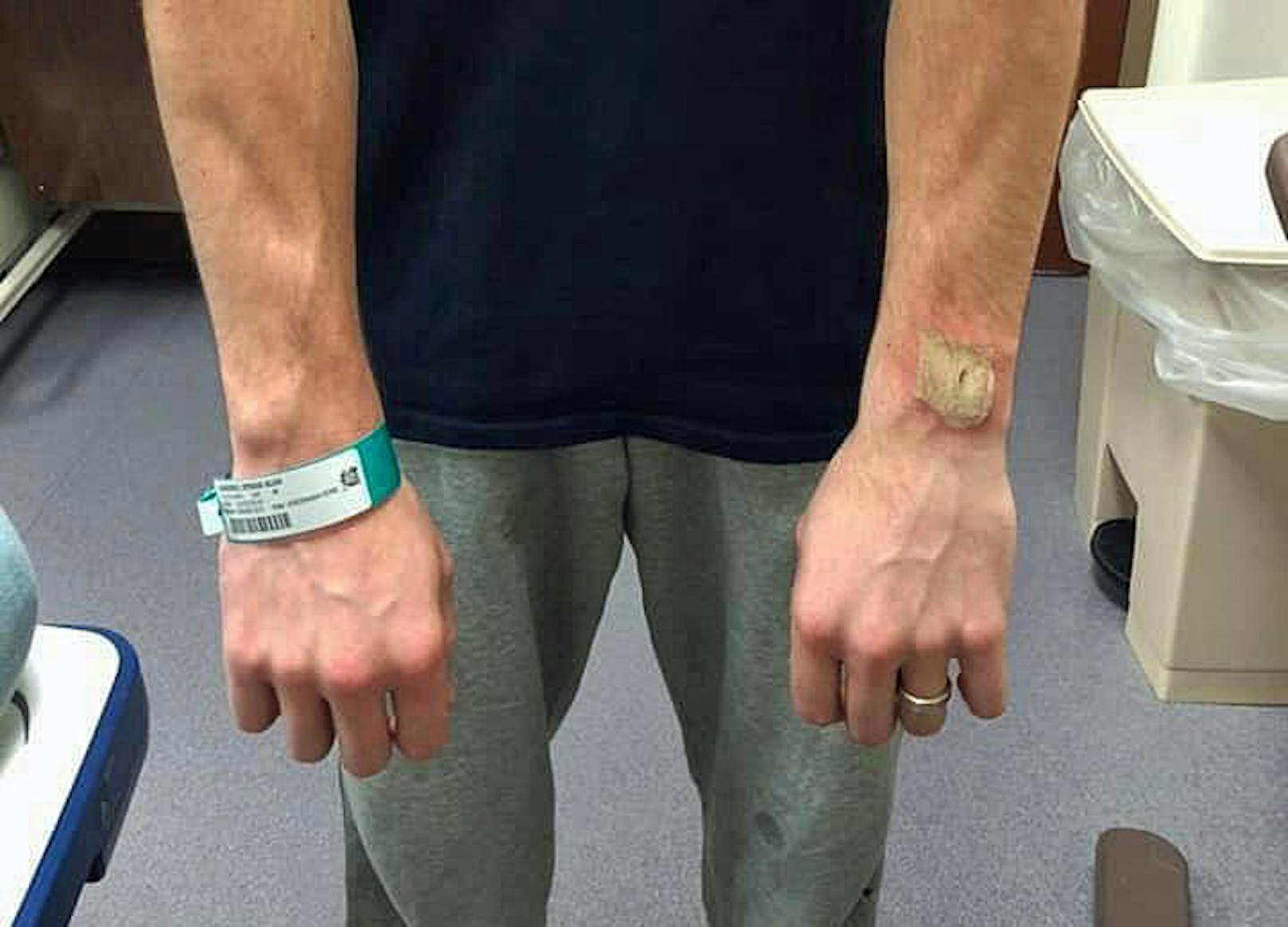 Der Amerikaner Ethan Landers musste ins Spital, nachdem seine Fitbit-Uhr im Schlaf am Handgelenk explodiert war, wie er sagt.