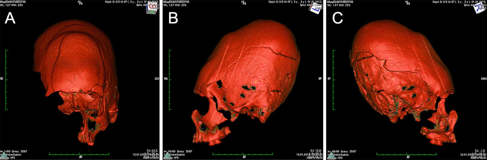 CT-Scan des Schädels