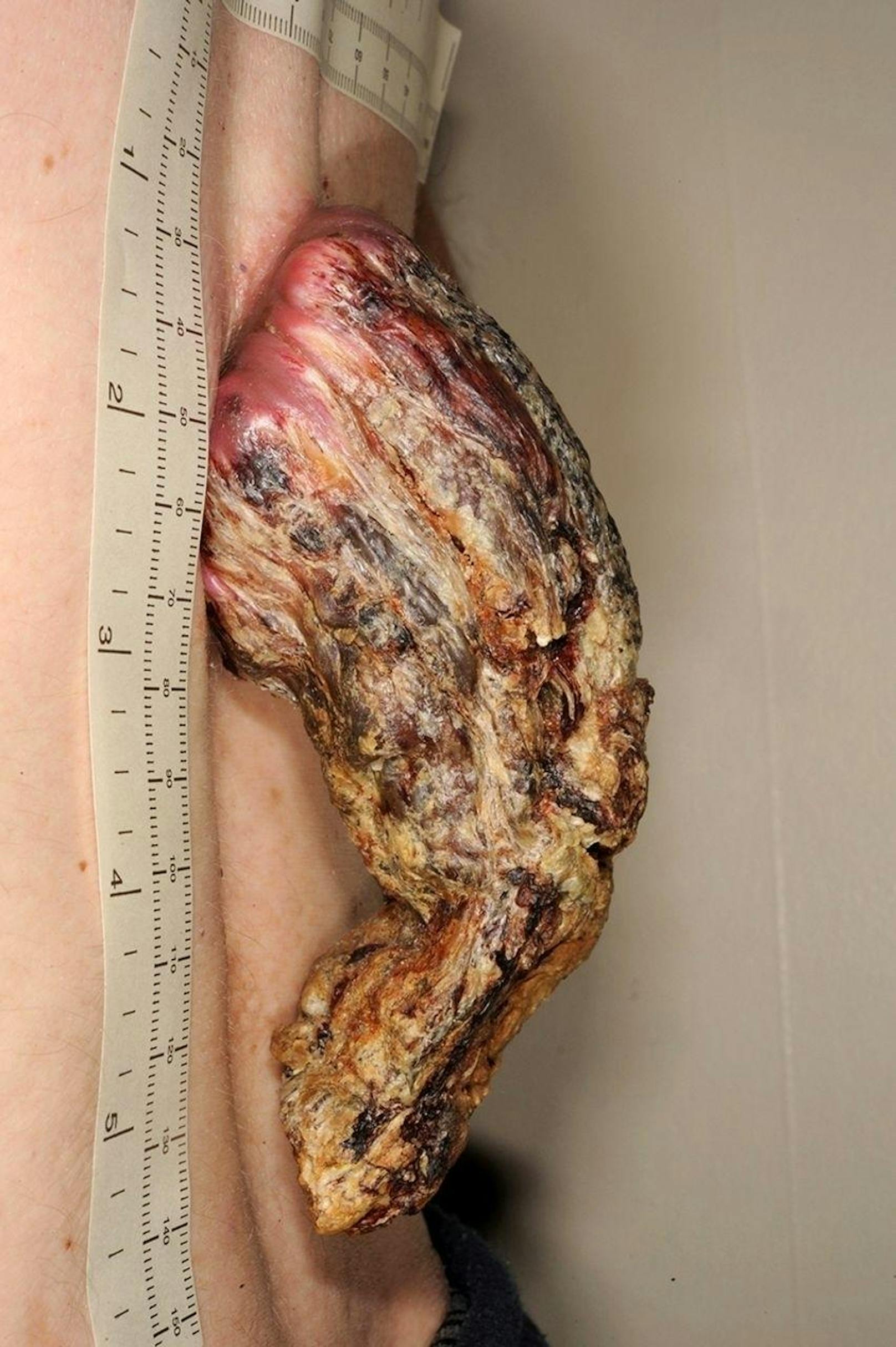 Ärzte in England mussten einem Mann einen bösartigen Hauttumor entfernen, der sich über Jahre zu einer Art Drachenhorn entwickelt hatte.