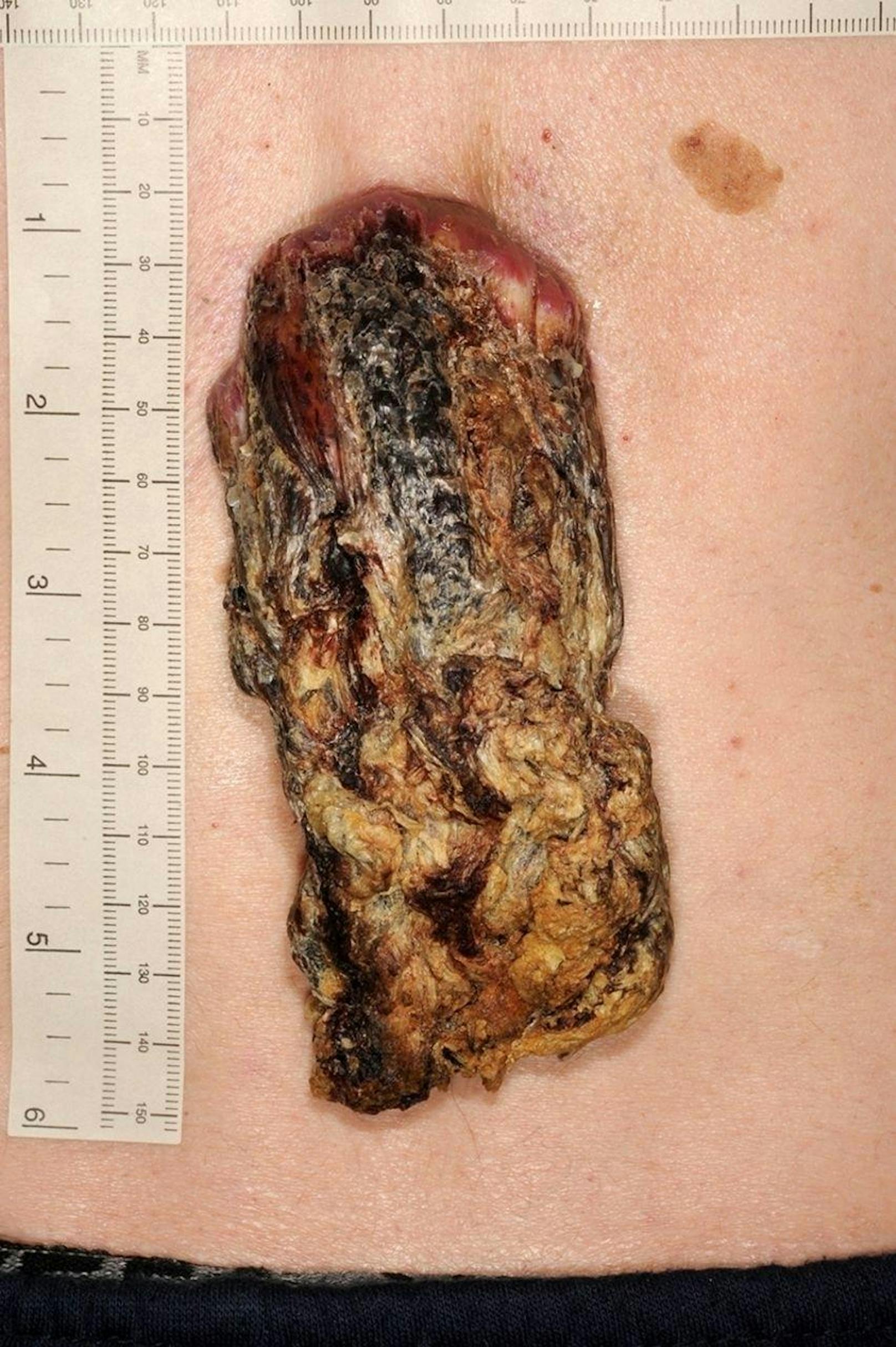 Ärzte in England mussten einem Mann einen bösartigen Hauttumor entfernen, der sich über Jahre zu einer Art Drachenhorn entwickelt hatte.