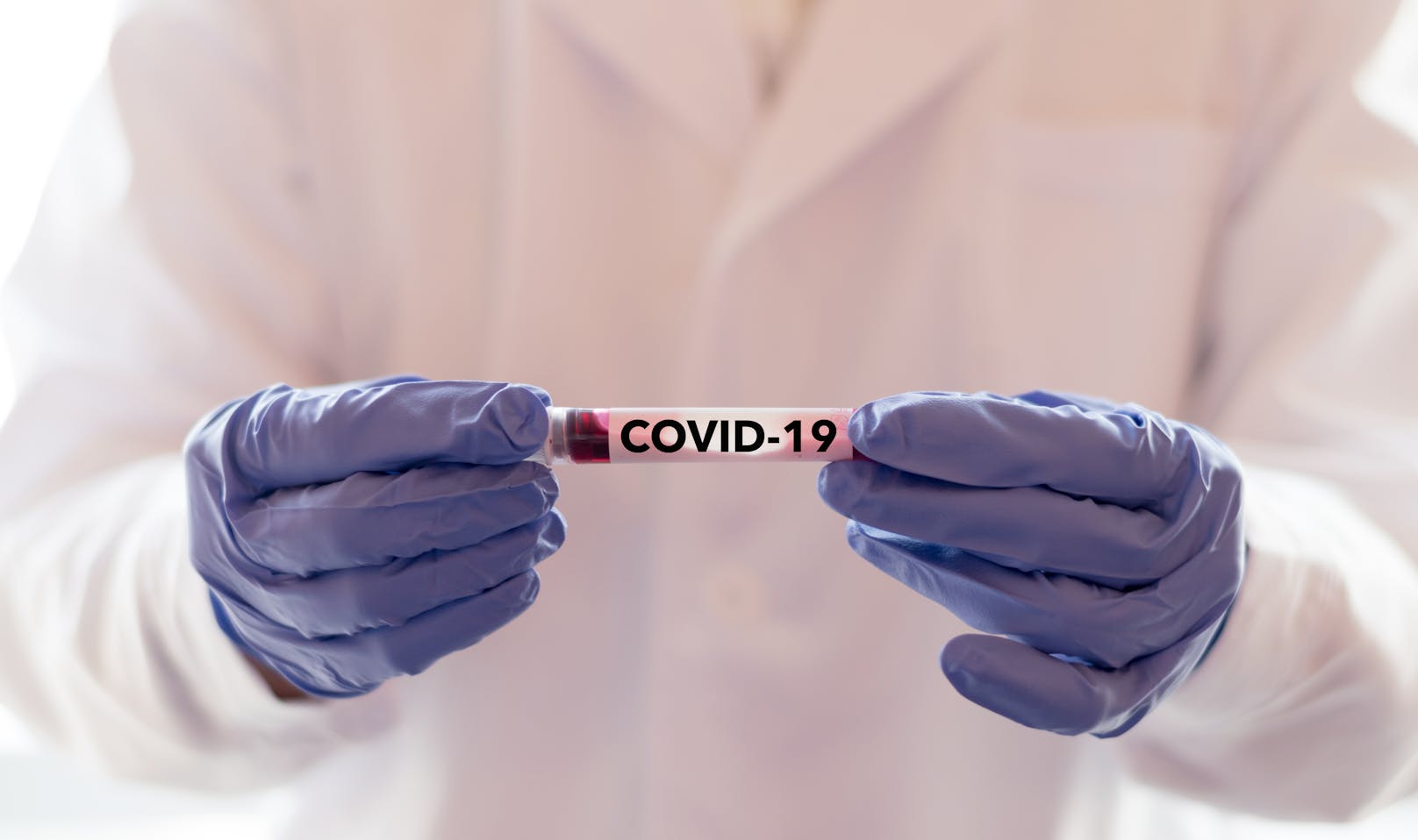 In der Studie identifizierten die Forscher im Blut von Covid-19-Patienten drei Stoffe, die eine Prognose möglich machen: ein Enzym (Lactatdehydrogenase, kurz: LDH), ein Eiweissstoff (hochsensitives CRP, im Bild) und die zu den weissen Blutkörperchen gehörenden Lymphozyten.