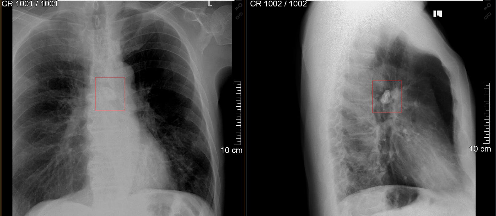 1-Cent-Stück aus Lunge eines Mannes operiert