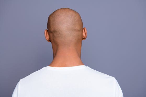 Menschen mit Glatze haben laut einer US-Studie ein höheres Corona-Risiko. Diese legt einen Zusammenhang zwischen der Schwere der Krankheit und Haarausfall nahe.