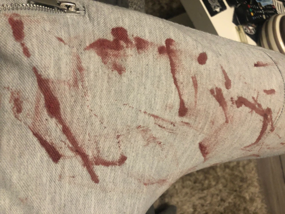 So sah die Hose des Opfers nach der Attacke aus.