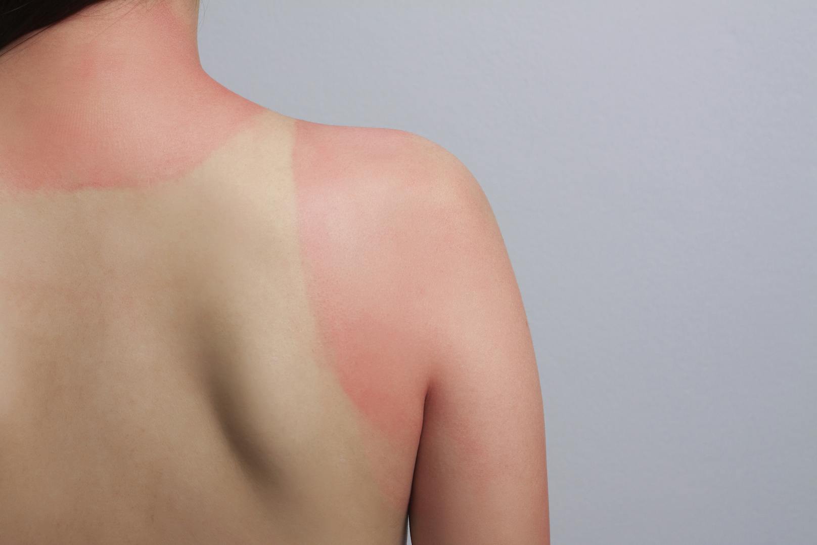 Ein Sonnenbrand ist extrem gefährlich für die Haut. Wenn die Vorsorge veragt, helfen diese Hausmittel.<br>