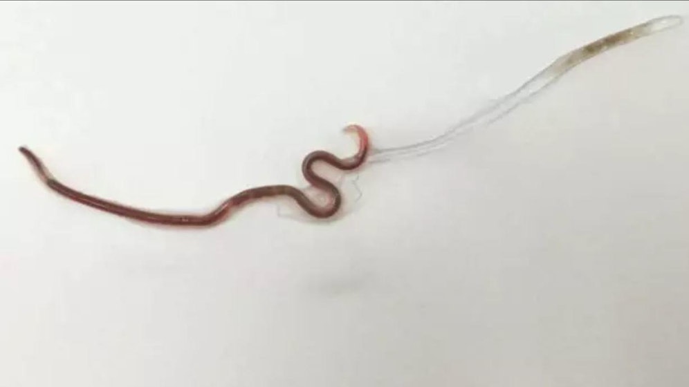 Dieser 3,5 Zentimeter lange Wurm befand sich im Rachen einer Frau.