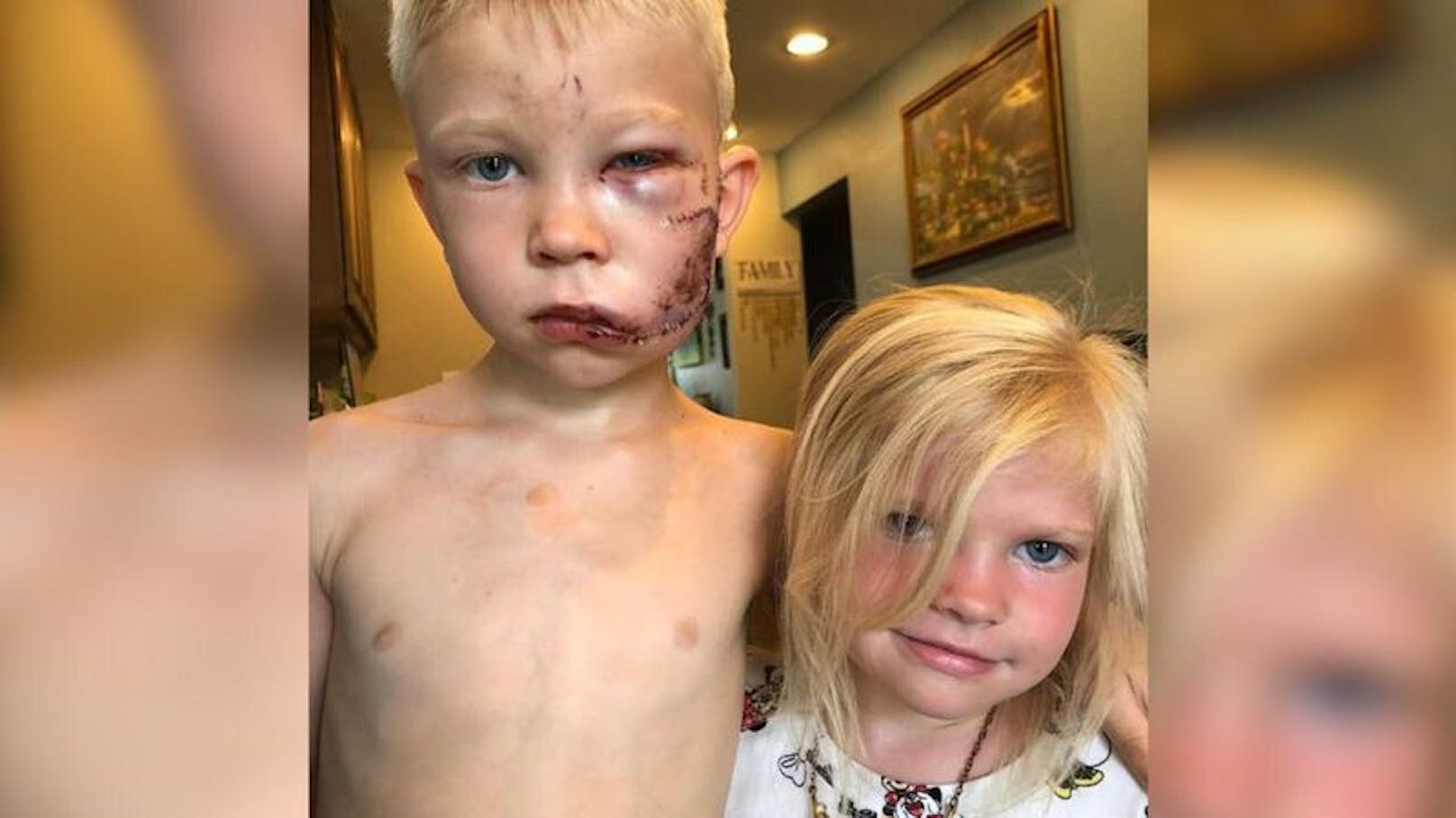 Sechsjähriger schützt seine Schwester vor Hundeangriff.