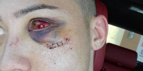 Boston Salmon schockiert seine Fans mit seinem verletzten Auge.