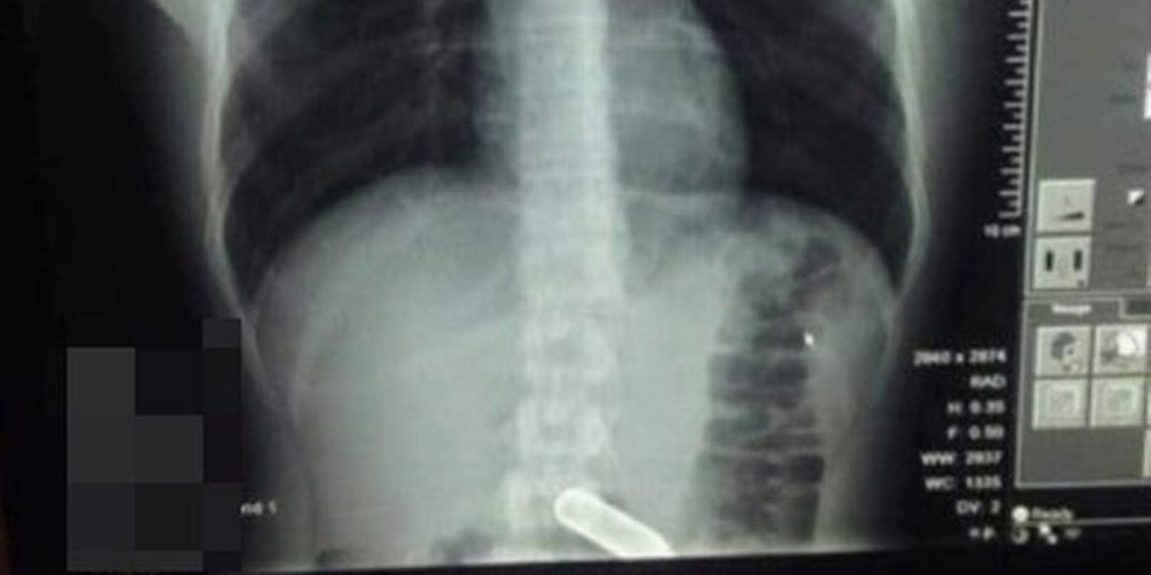 Das Röngtenbild zeigt die Lachgas-Kapsel im Magen des 22-Jährigen