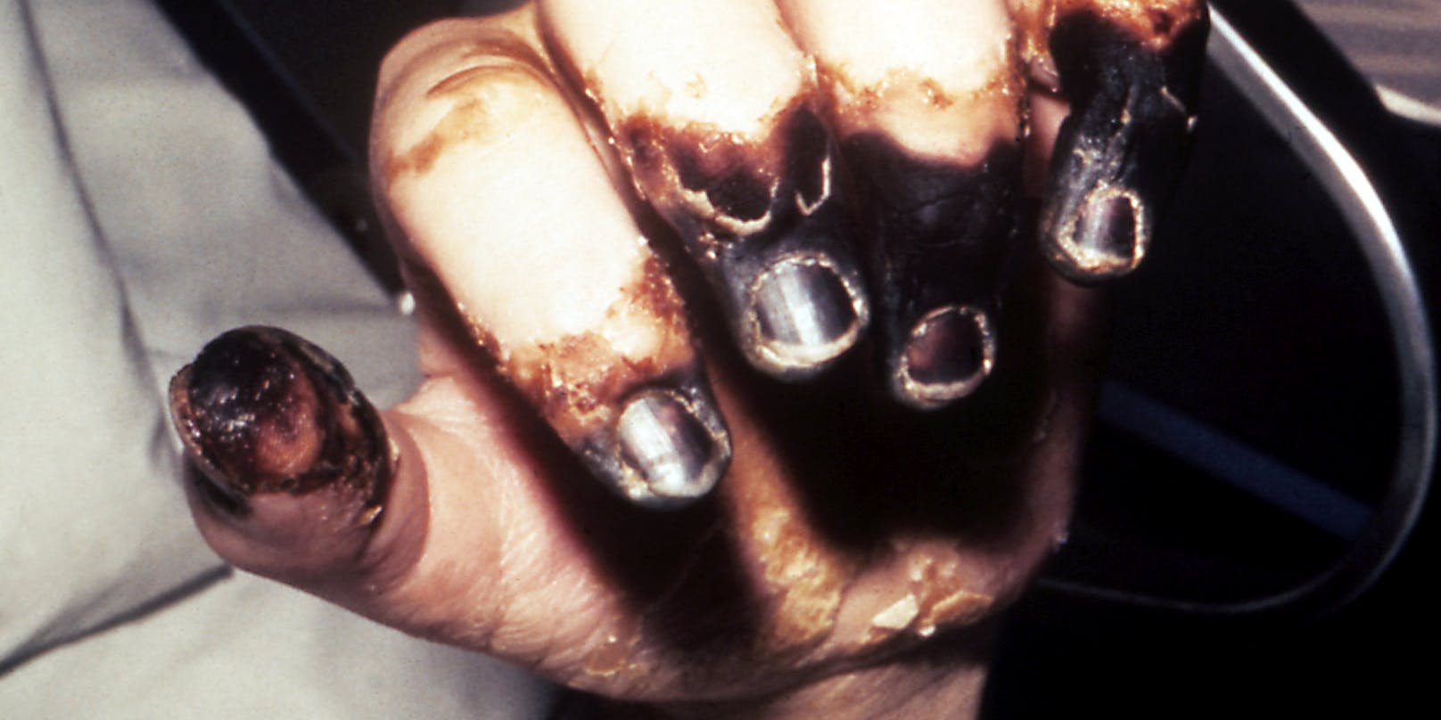 Nekrose in den Fingern in Folge einer Ansteckung mit der Beulenpest. Symbolfoto