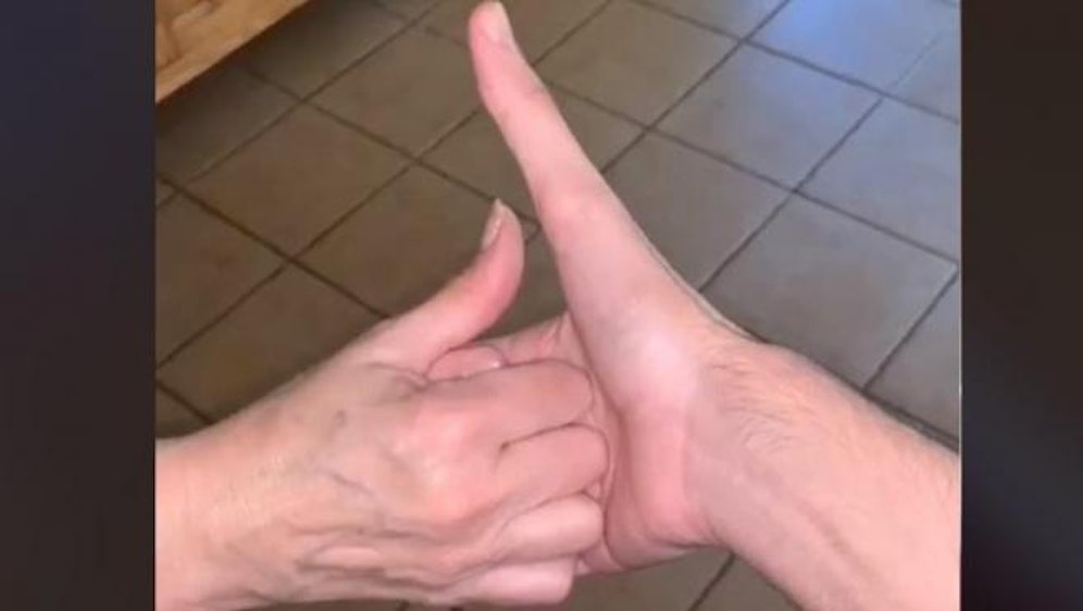 Hat Jakob Pina den längsten Daumen der Welt? 