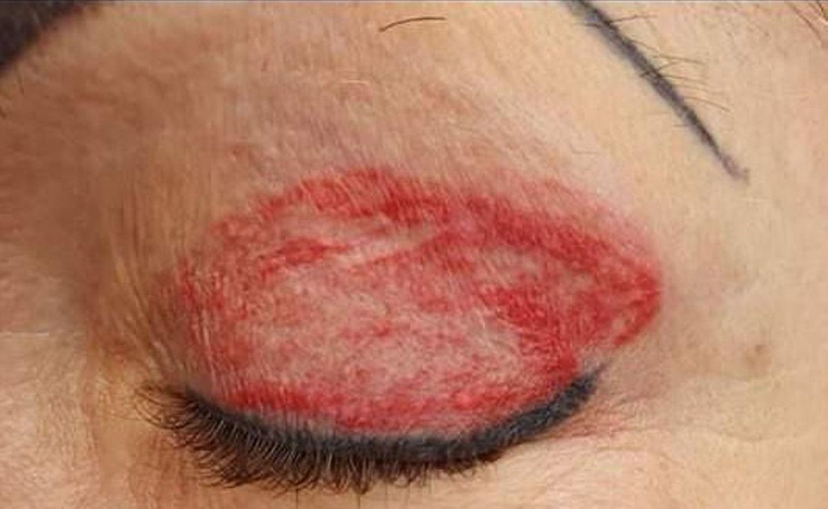 Ihre Lider waren komplett gerötet.