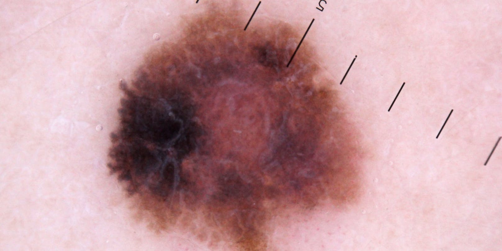 Ein Melanom ist ein dunkler Tumor und die bekannteste Form von Hautkrebs. 