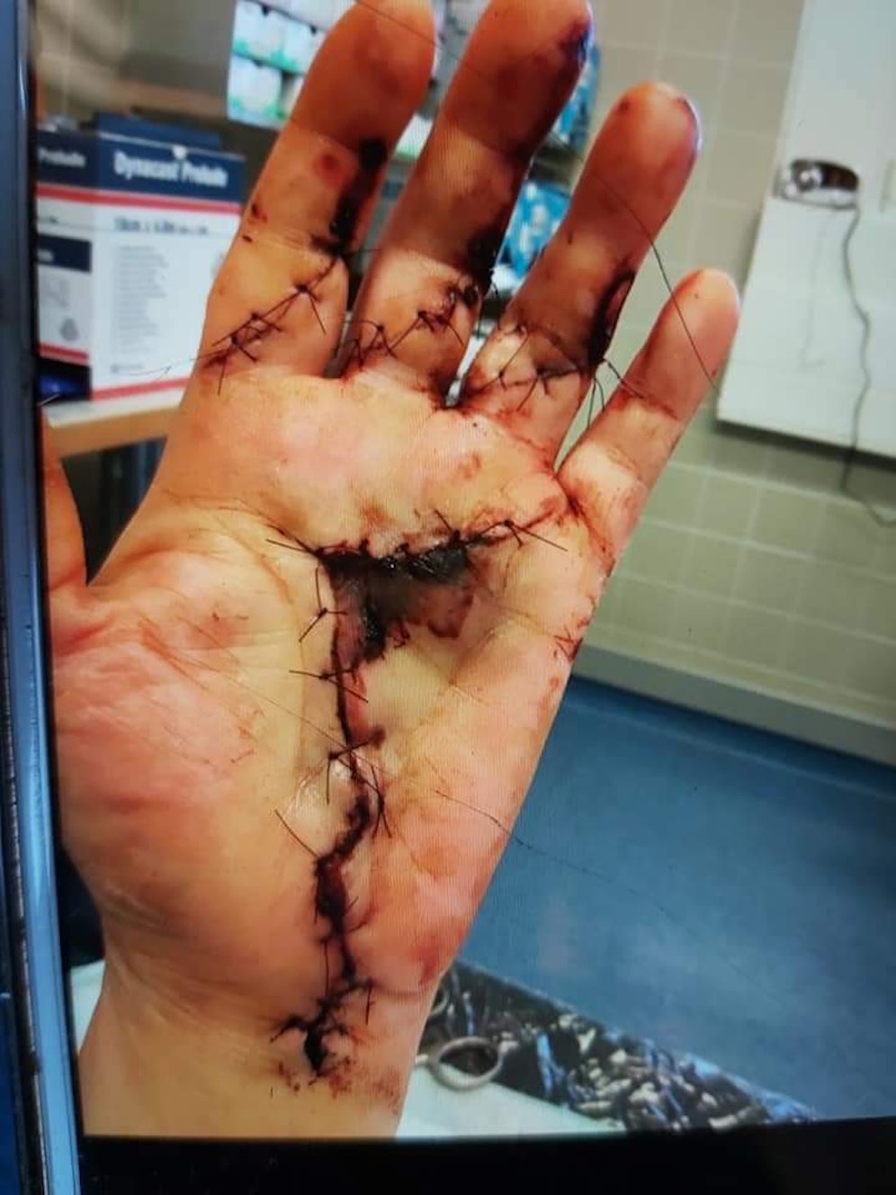 Eine Leobersdorferin wurde von einem freilaufenden Hund gebissen.