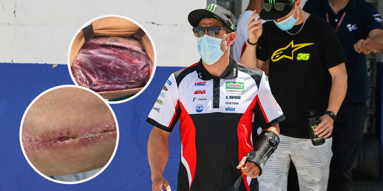Sportmix – MotoGP-Star zeigt Grusel-Bilder von Arm-Operation | Heute.at