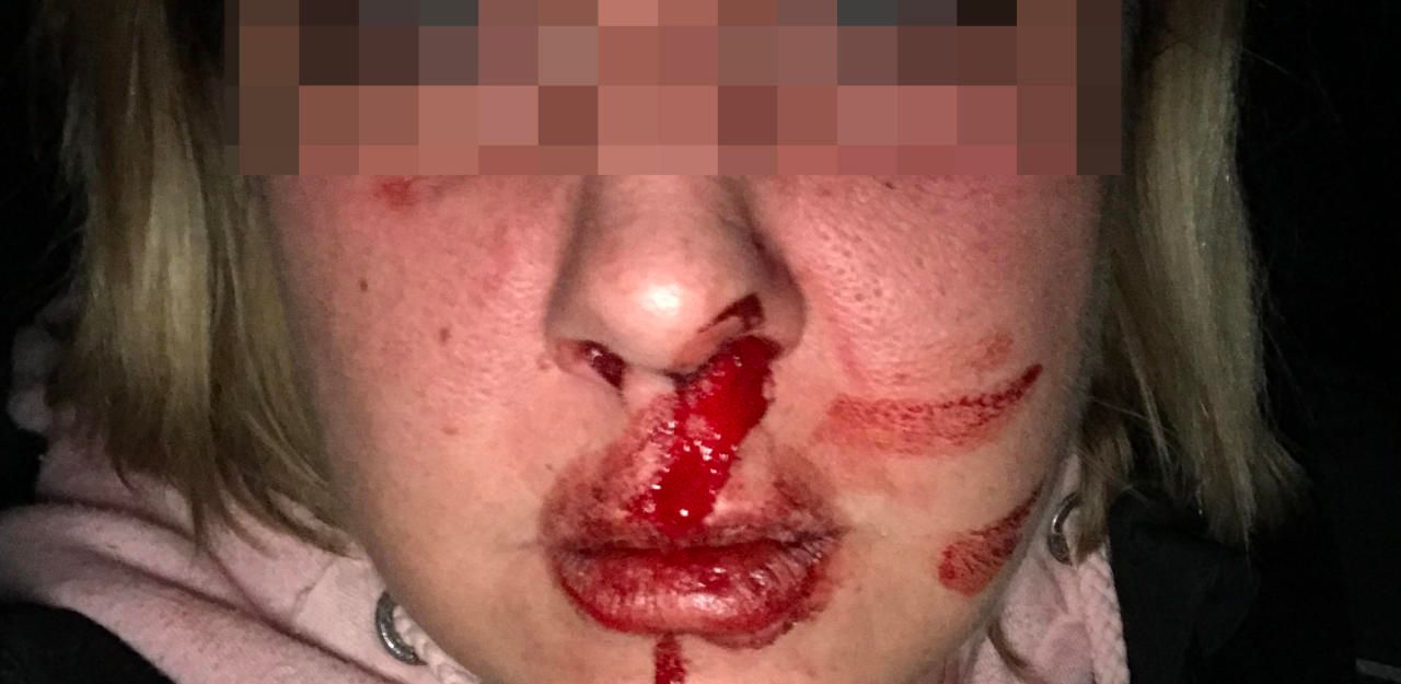 Heute.at - Partner-Tattoo, dann wurde Wienerin verprügelt