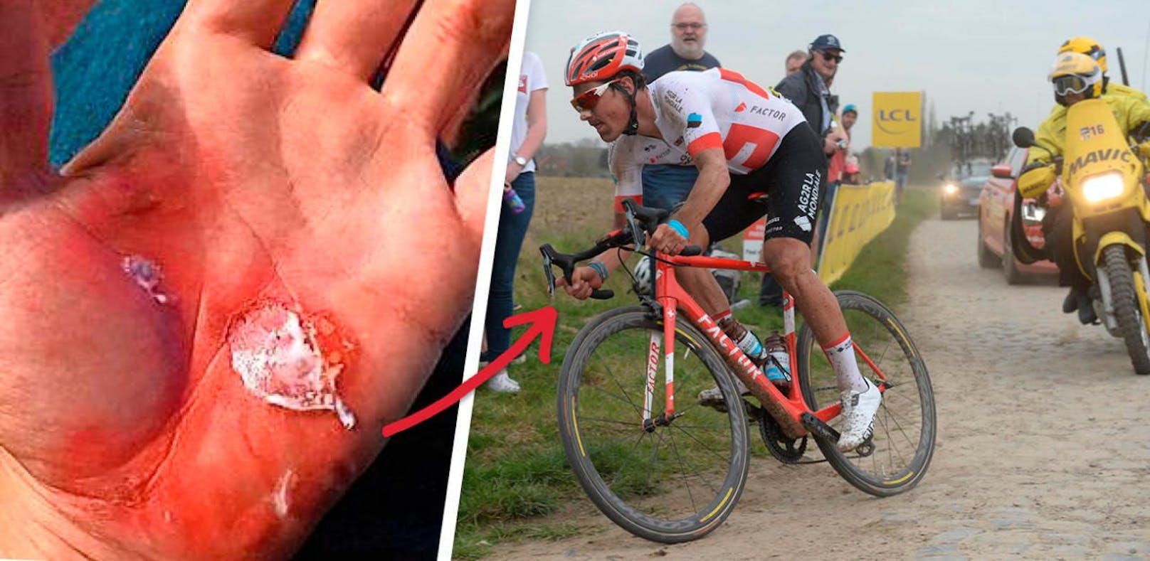 Das tut bereits beim Hinsehen weh! So sehen die Hände des Schweizer Rad-Profis Silvan Dillier nach Paris-Roubaix aus. 