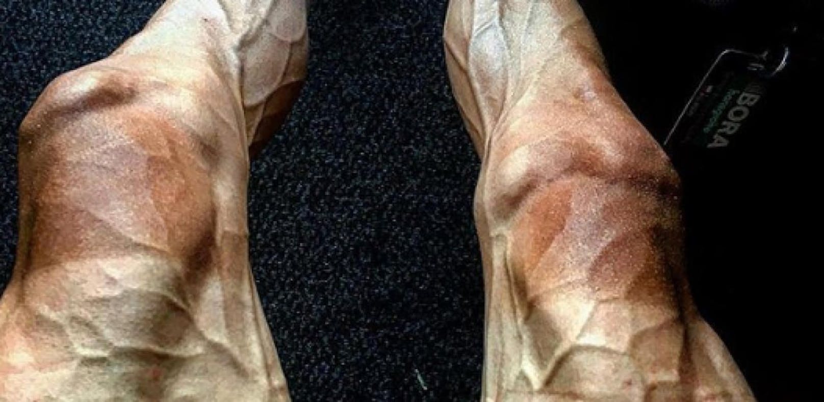 Bild geht um die Welt: Arzt erklärt die Grusel-Beine