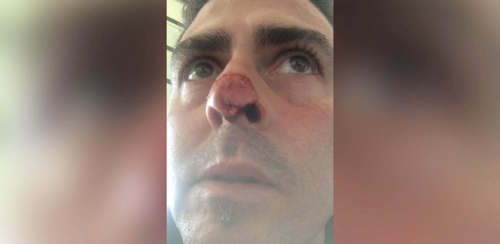 Die Verletzung an der Nase: Diego Morero musste mit zwei Stichen genäht werden