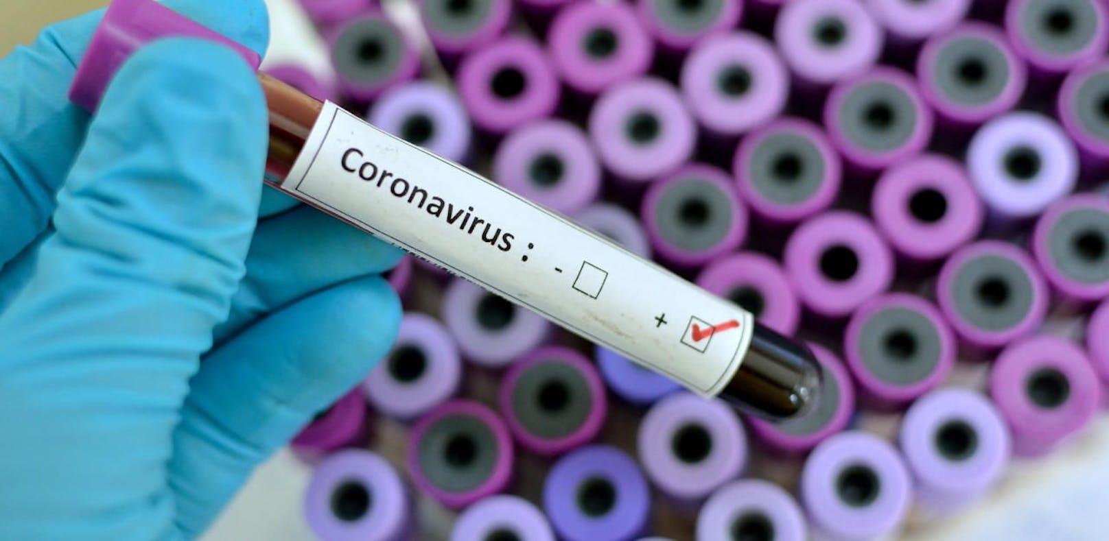Die Frau war mit dem Coronavirus infiziert.