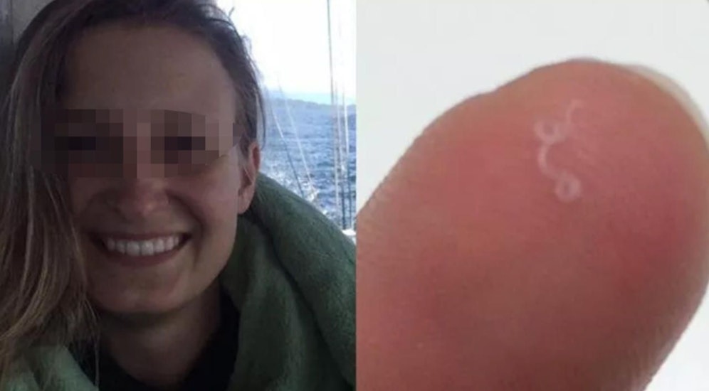 Jetzt lacht sie wieder: Opfer Abby B. (28) hatte 14 lebende Würmer im Auge. Sie wurden entfernt.