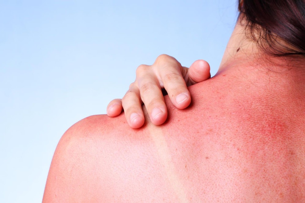 Mit jedem Sommer ist er bei den meisten zurück: Der Sonnenbrand. Wie man ihn behandeln kann, zeigen wir hier! 